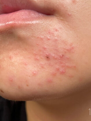 Close de queixo com crise de acne e irritação