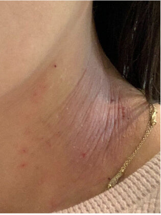 Close de pele do pescoço com eczema