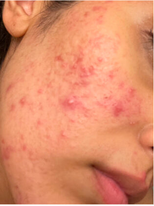 Close de bochecha com espinhas inflamadas
